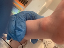 Hard lumps on babes ankle / foot