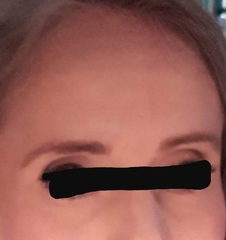 I got Botox today for the first time