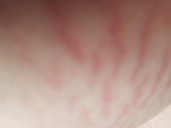 Early stretchmarks or something else?