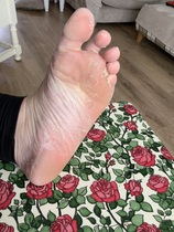 It has begun...... warning this post is about peeling skin