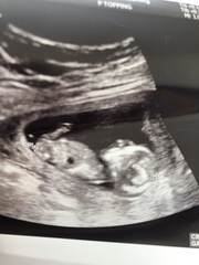 13 week scan