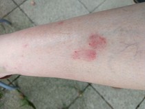 To ask if you recognise this rash?