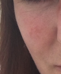 Is this cystic acne?