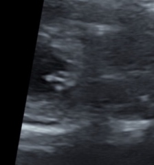 Re scan day!!! Fingers crossed!