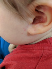 MMR side effects?