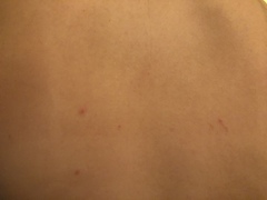Rash advice please!