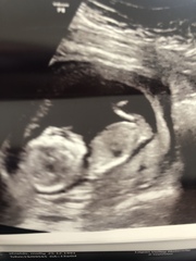 13 week scan