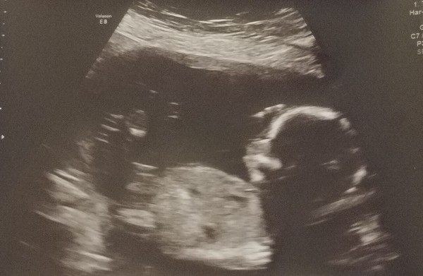 The Graduates of TTC after pregnancy loss thread #3 🐧🐧The Penguin Huddle 🐧🐧