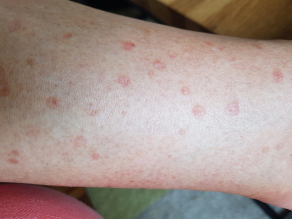 What could this be on my leg (with pic)