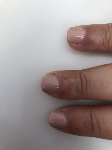 Peeling skin on fingers