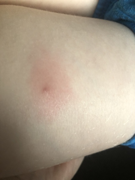 Insect bite ?
