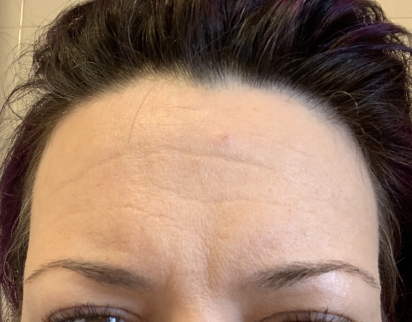 Botox advice, please