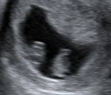 Long shot - any sonographers/obs on here please? Possible monoamniotic twins.