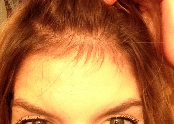 Regaine ( Rogaine) for hair.