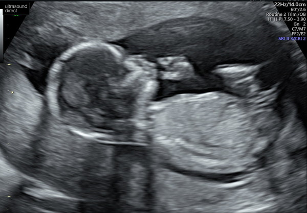 The Graduates of TTC after pregnancy loss thread #3 🐧🐧The Penguin Huddle 🐧🐧