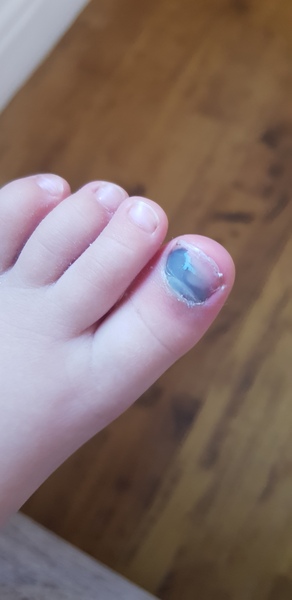 Take 3yo to A&E with toe injury?
