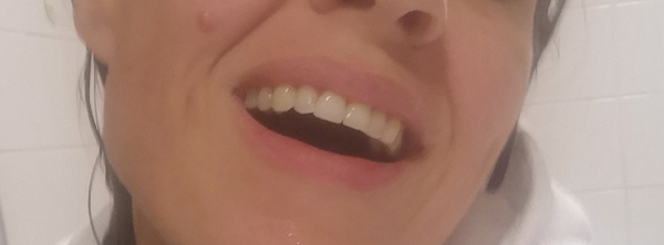 Invisalign- tell me to woman up!