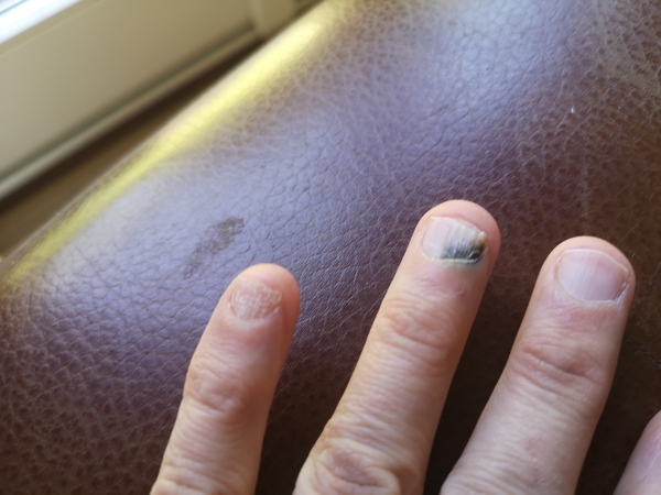 What is wrong with my nail? Picture attached