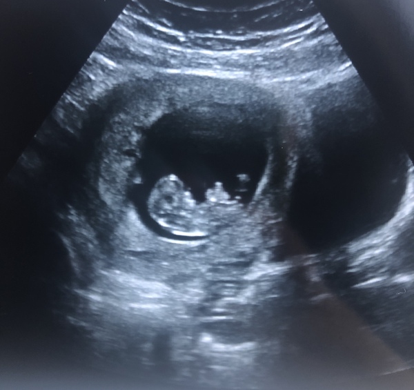 Boy or girl?