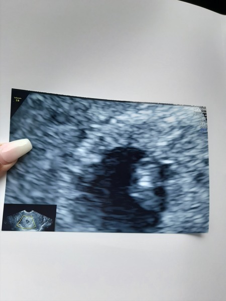 Ectopic or IBS