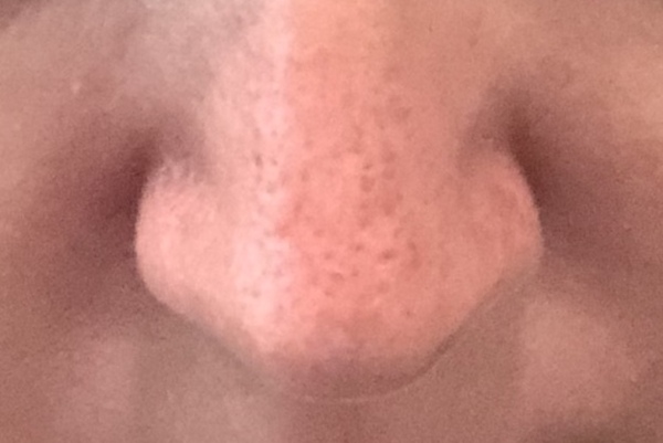 Improving skin on nose?!