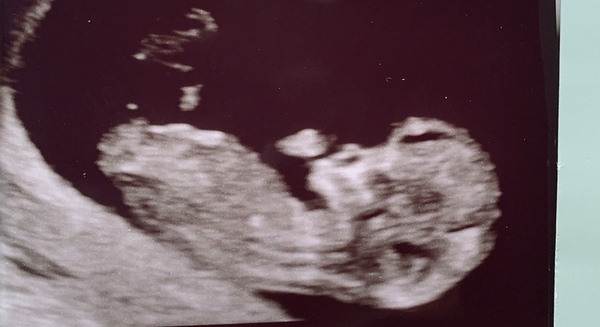Anyone guess the gender ? 💗💙