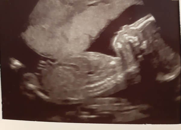 20 week scan opinions please!