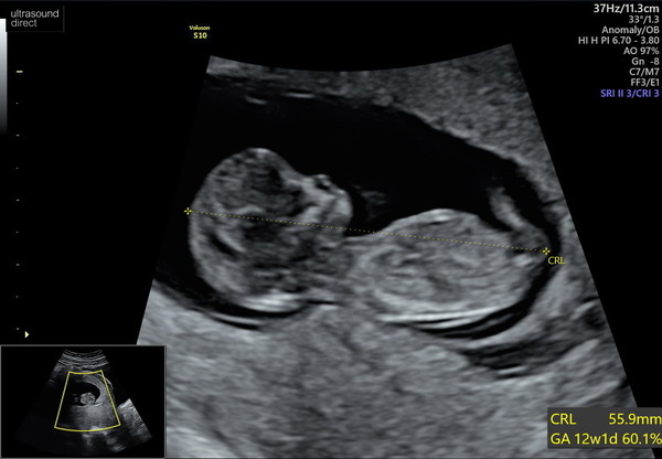 BFP - Anyone else feb 2020? Continued ...