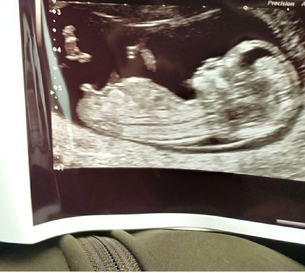 Boy or girl guesses?