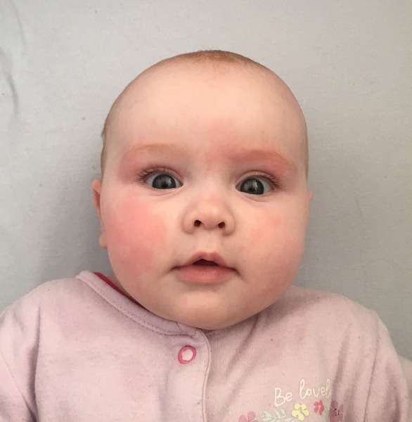 What is this rash on my baby?!