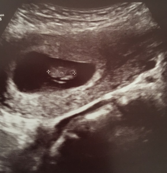 The Graduates of TTC after pregnancy loss thread #3 🐧🐧The Penguin Huddle 🐧🐧