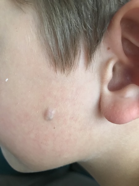 Mole / wart growth on DS' face