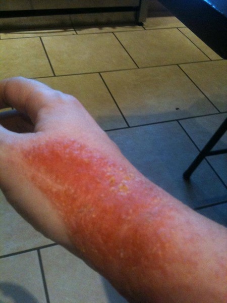 Bloody cat infected hand