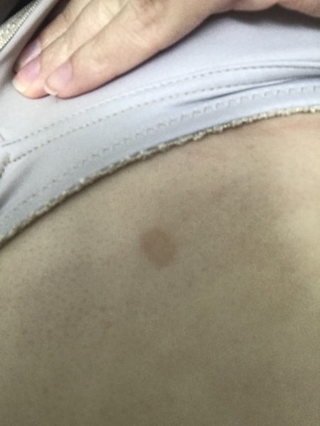 Large mole - worried about melanoma