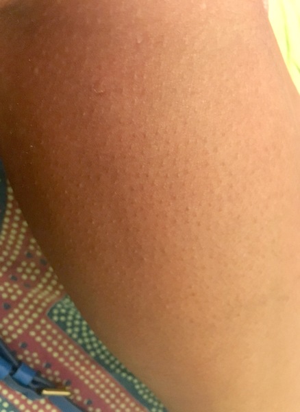 What to do about “strawberry skin” on legs? (With photo)