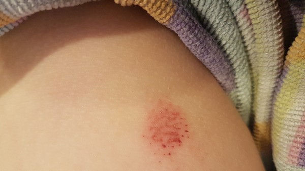 worried about bruise/mark on 5 year old