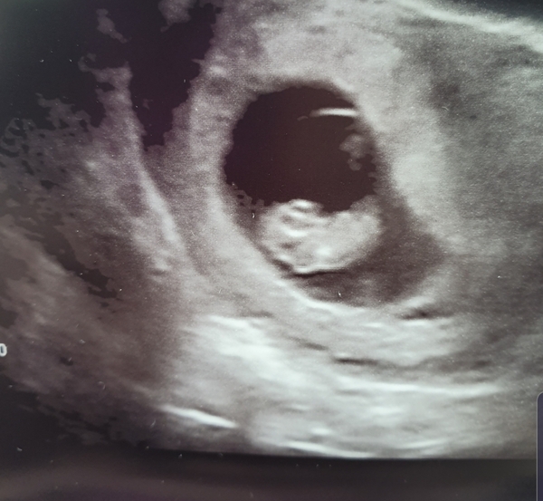 Due March 2020 - FIRST BABY in late 20's