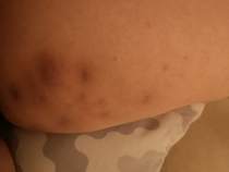 Help - boils! *PHOTOS INCLUDED*