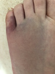 Nothing they can do about a broken toe is there. **pic** not very pretty.