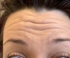 Botox advice, please