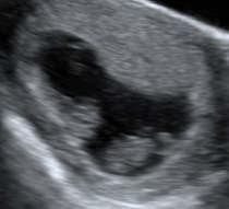 Long shot - any sonographers/obs on here please? Possible monoamniotic twins.