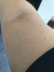 Does this look like heat rash/an allergic reaction/something else?