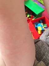 Rash