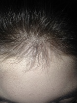 Regaine ( Rogaine) for hair.