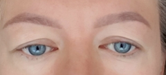 Does anyone know about upper eyelid blepharoplasty?
