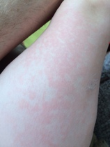 Rash