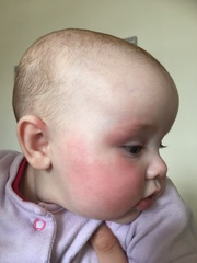 What is this rash on my baby?!