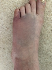 Nothing they can do about a broken toe is there. **pic** not very pretty.