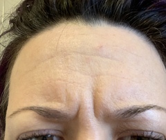 Botox advice, please