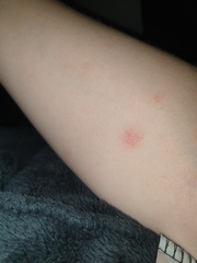 Dry patches driving me crazy!!
